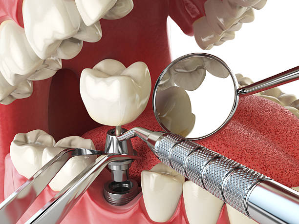 Best Emergency Root Canal Therapy in Laguna Niguel, CA